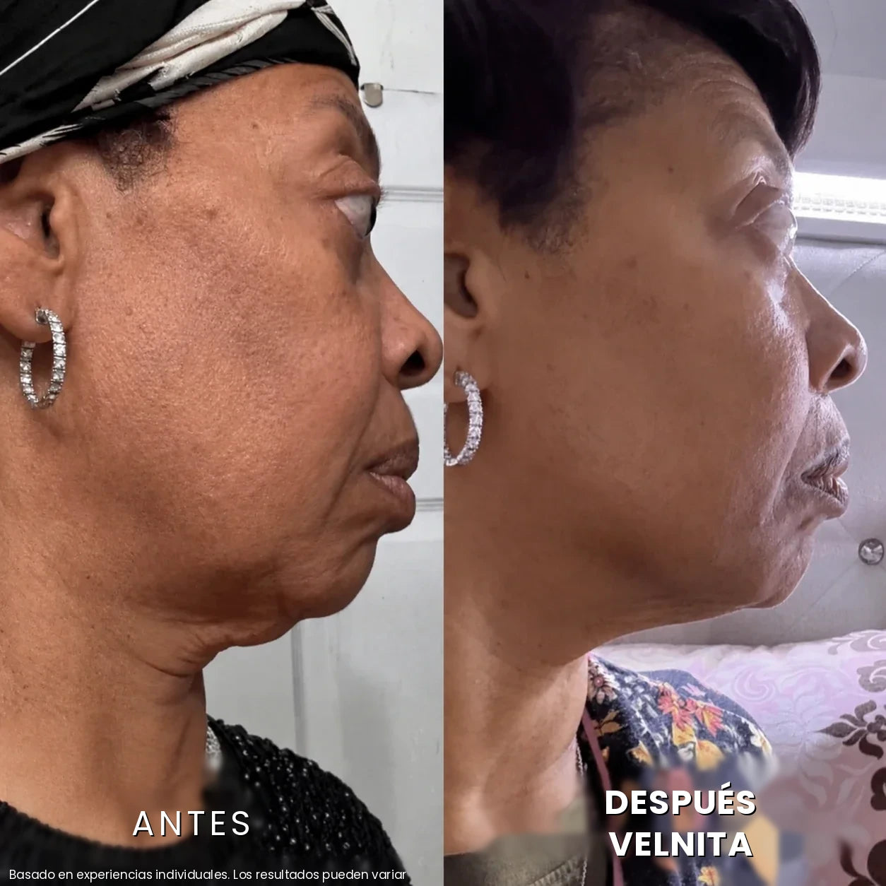 Antes / Después 6